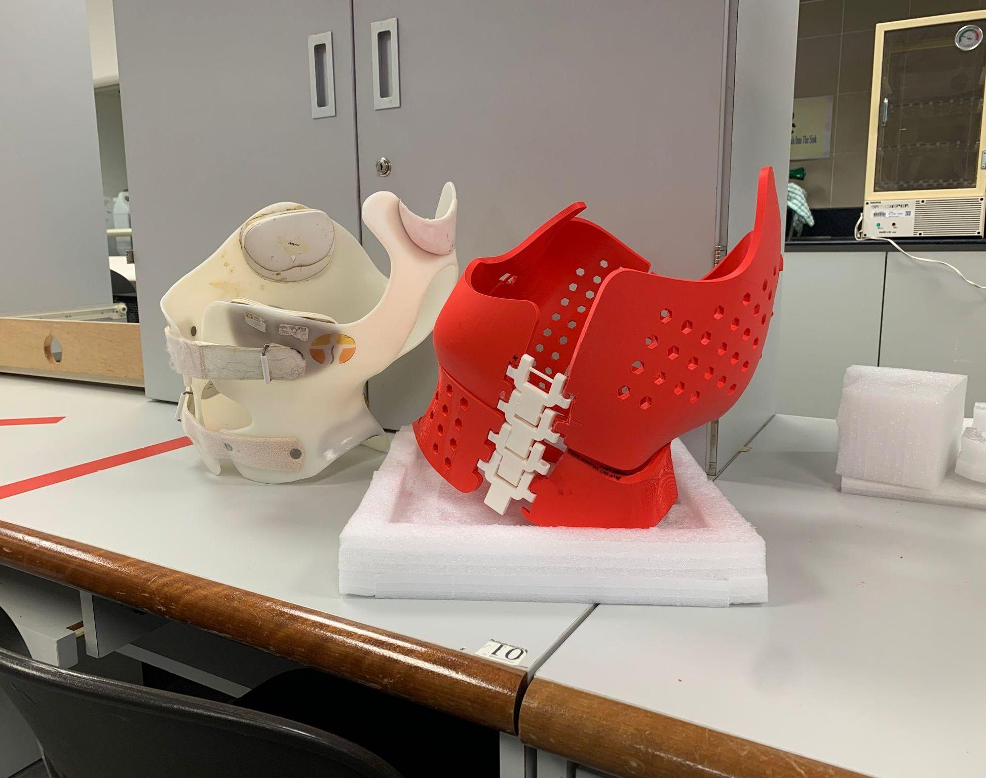 3D Printed Back Brace for Scoliosis