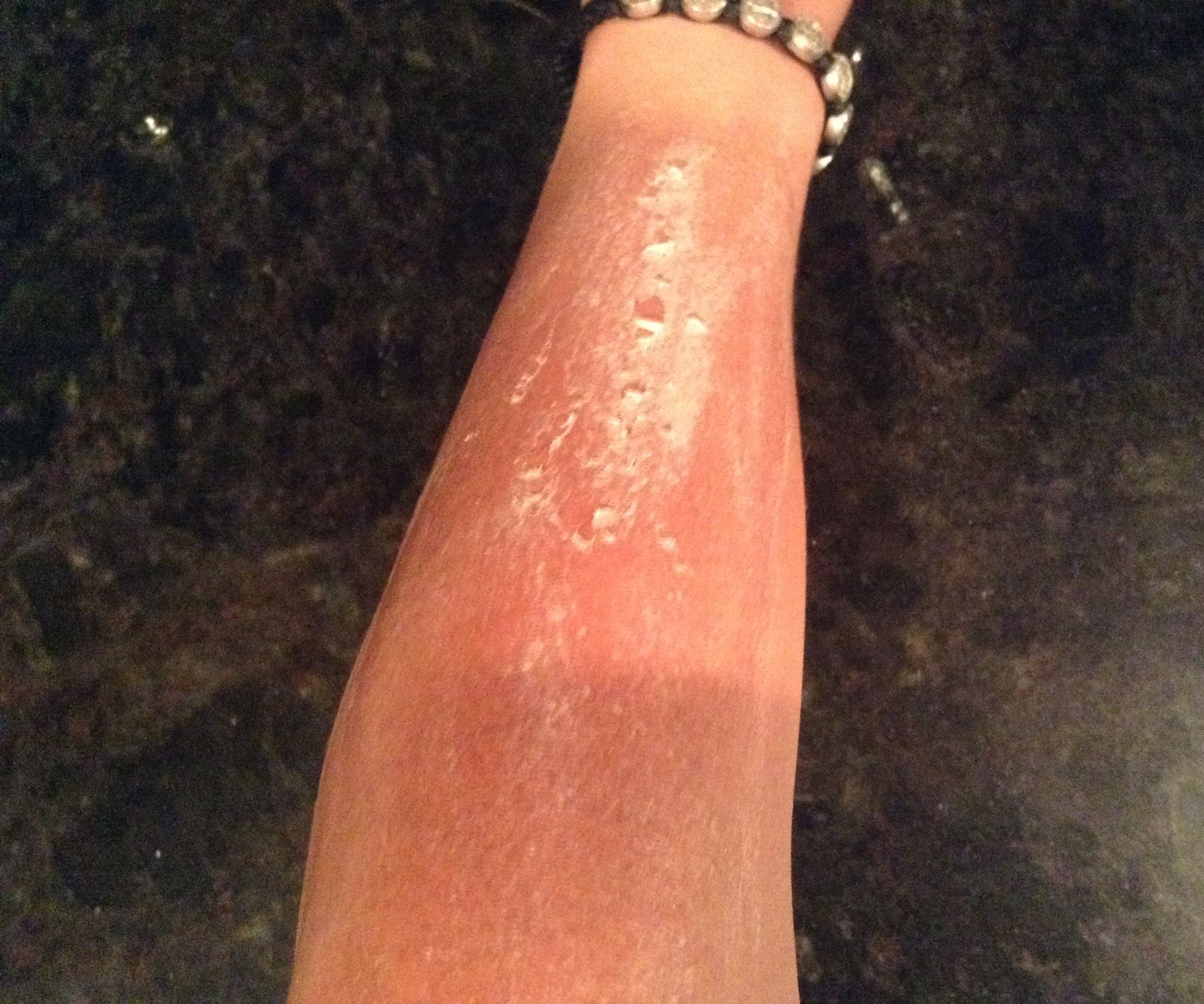 How to Scrape Your Arm 